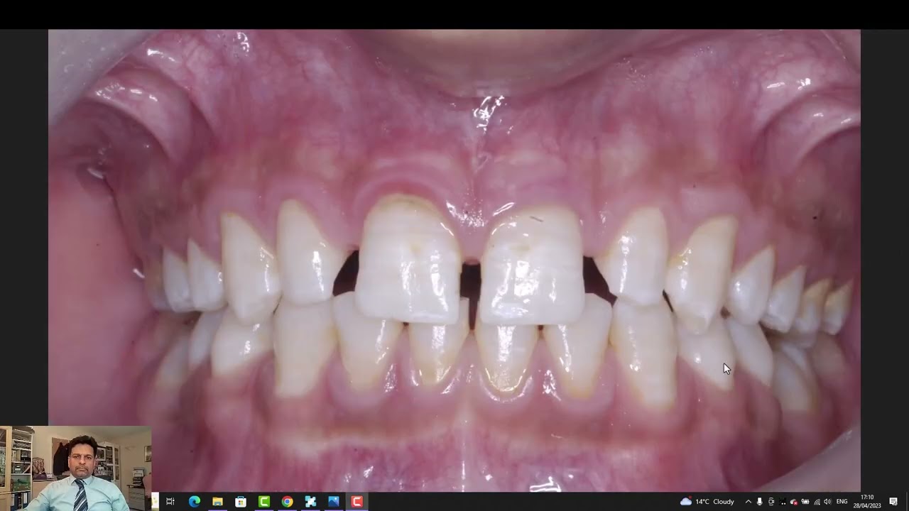 Gappy teeth closed with Spark aligners