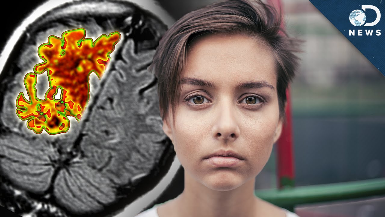 Can Alzheimer's Start In Your 20s?