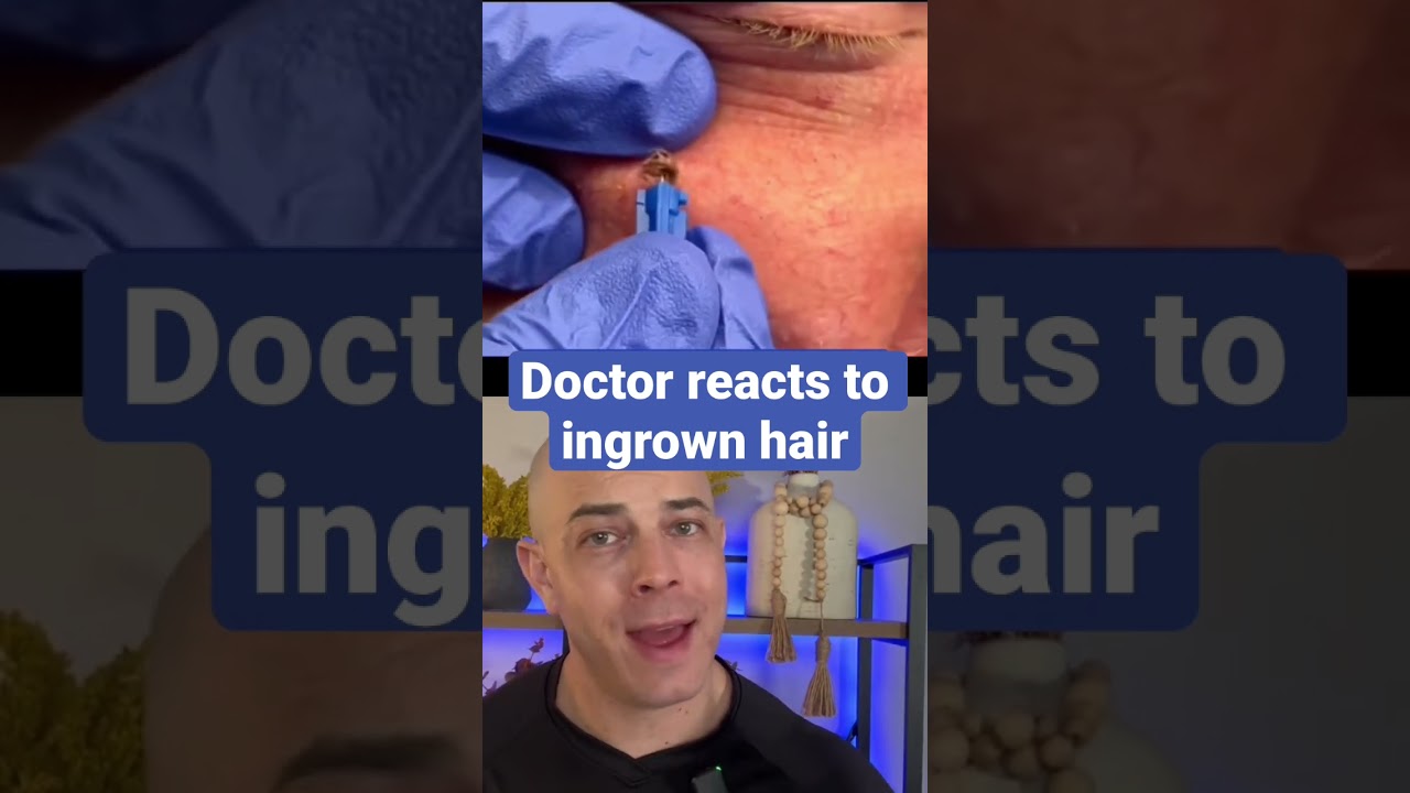 Doctor reacts to gnarly ingrown hair!!