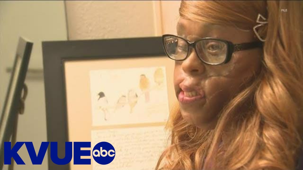 Domestic violence survivor Carolyn Thomas underwent 27th reconstructive surgery | KVUE